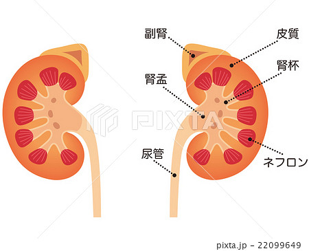 腎移植のイラスト素材