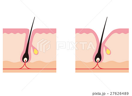 毛穴の断面 開いた毛穴のイラスト素材 [27626489] - PIXTA