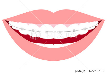 歯列矯正のイラスト素材