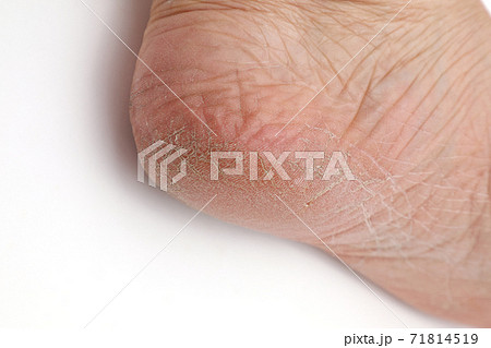 肌割れの写真素材