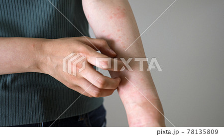 ストレスで腕に湿疹が出る女性の写真素材 [78135809] - PIXTA