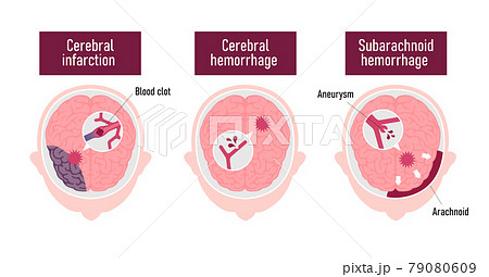 脳出血のイラスト素材