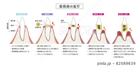 歯周病のイラスト素材